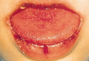 content_口唇の紅潮_いちご舌_口腔咽頭粘膜のびまん性発赤